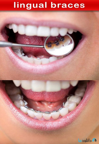 استوک-lingual-braces