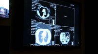 دانلود-مستند-BBC-Horizon-Defeating-Cancer